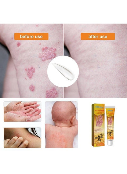 South Moon - Bee Venom Psoriasis Care Cream (Original)